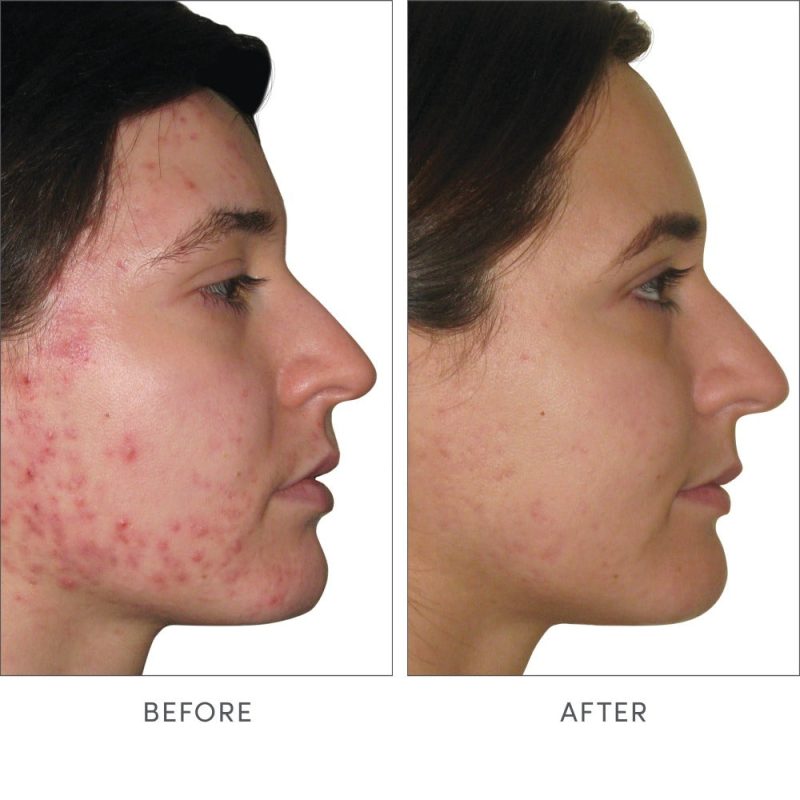 IC SkinAccumax BeforeandAfter altimage 2772x2772 2000x e3e2aea3 b263 4bd8 9593 e368059b1695