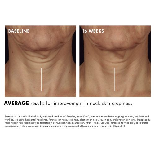 Tripeptide R Neck Repair2