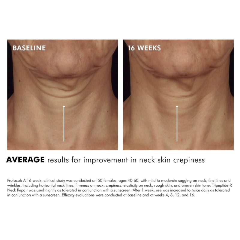 Tripeptide R Neck Repair2