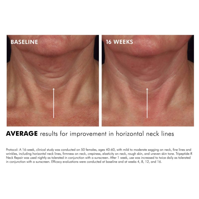 Tripeptide R Neck Repair3