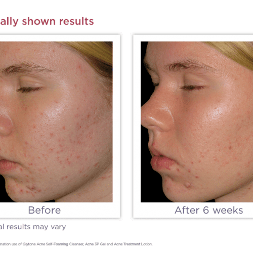 acne self foaming cleanserbeforeafter