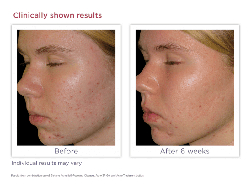 acne self foaming cleanserbeforeafter